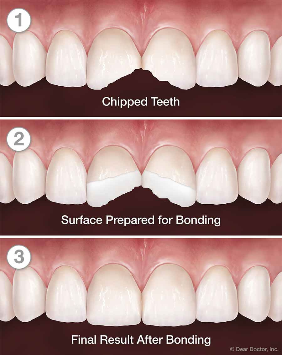 Bellingham Snohomish Cosmetic Bonding
