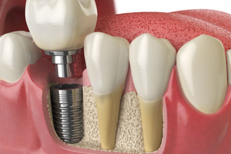 Bellingham Snohomish Dental Implants