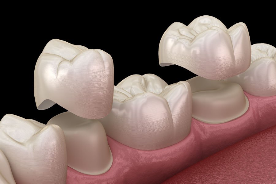 Bellingham and Snohomish Porcelain Crowns