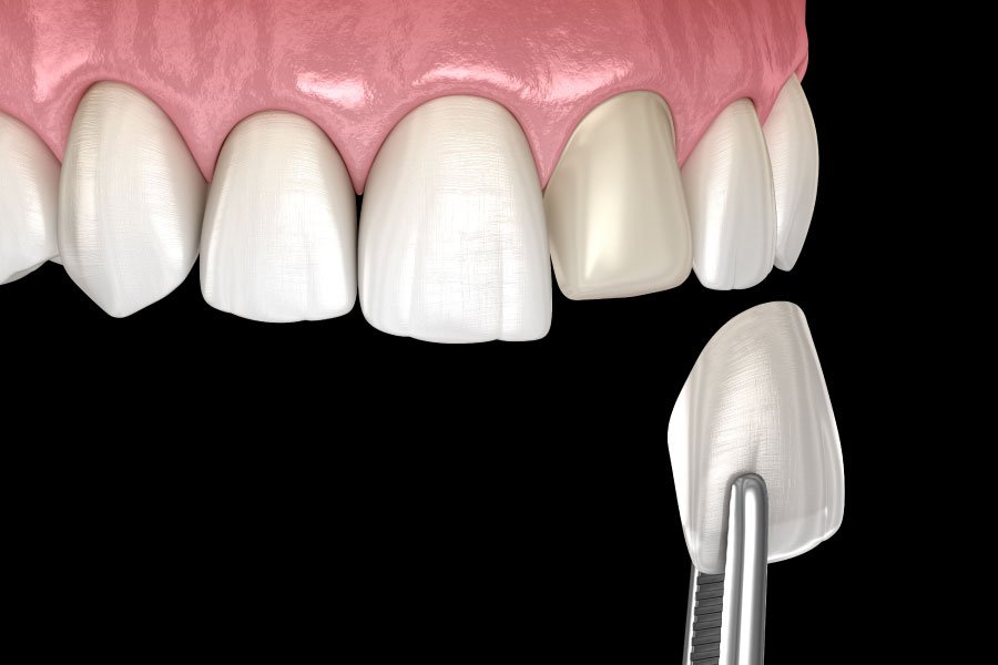 Snohomish Snohomish Porcelain Veneers