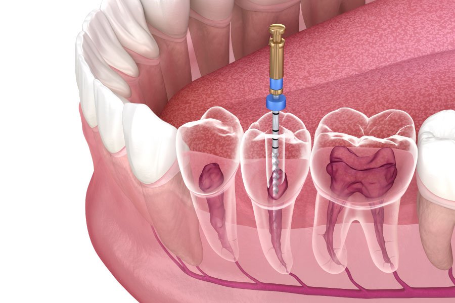 Snohomish and Snohomish Root Canals